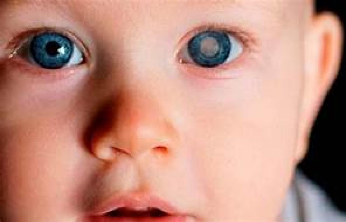 un bebé con catarata congénita en primer plano